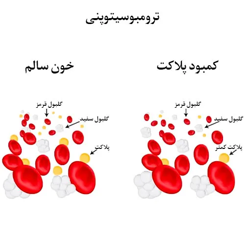 درمان ترومبوسیتوپنی (تعداد کم پلاکت خون) با داروی لوسوترومبوپگ